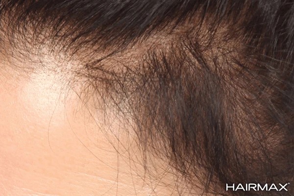 na resultaat hairmax laserkam tegen haaruitval