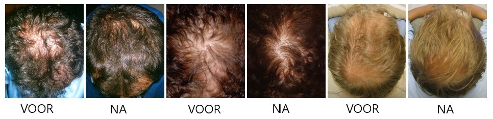 voor en na revivogen scalp therapy